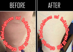 infrared light therapy before and after leg veins